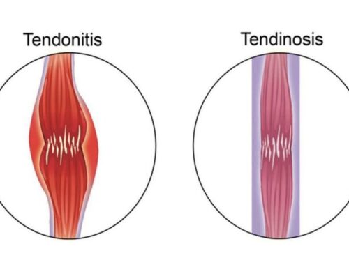 UNDERSTANDING THE DIFFERENCE: Tendinopathy, Tendinitis, and Tendinosis